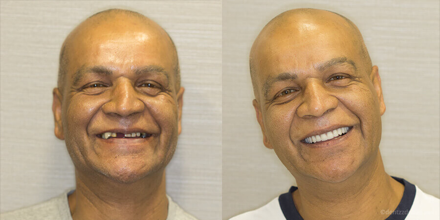 mRyAoP-hslJVr-dental-implant-1_PMTh